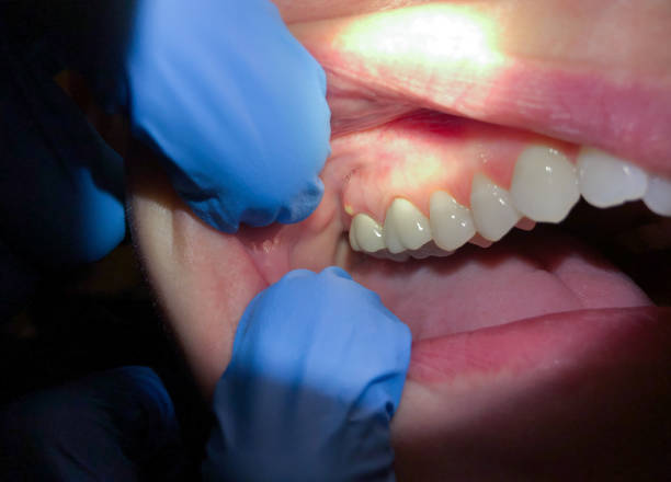 Best Emergency Treatment for Dental Infections or Abscesses in Red Oak, IA